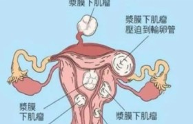 残角子宫能治愈吗做试管能成功吗？